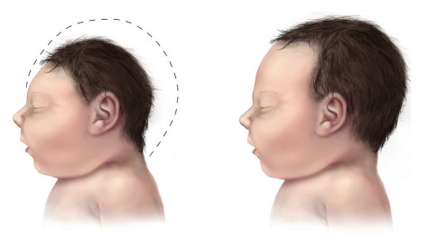 A side-by-side comparison of a child born with mycrocephaly—a birth defect linked to the Zika virus—and a child born without it. )Credit: Centers for Disease Control and Prevention)