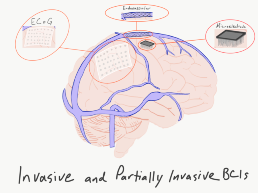 Drawing+of+the+brain+after+BCI+surgery.+Courtesy+of%3A+Amcclanahan